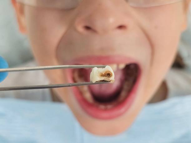 Best Pediatric Emergency Dentist in Watauga, TX